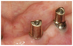 Implantataufbauten für teleskopgetragenen Zahnersatz