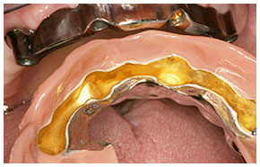 Steggetragener Zahnersatz auf 4 Implantaten im Oberkiefer
